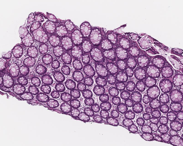 Non-tumor