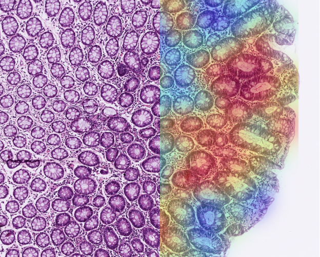 Adenoma, LGD