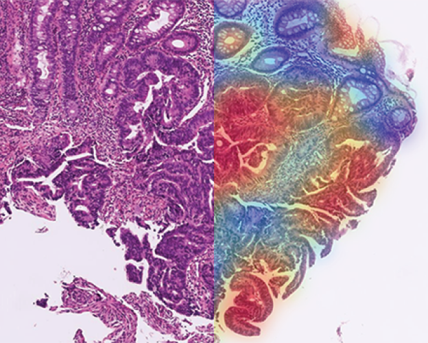 Adenocarcinoma